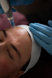 Skin Needling Package – Buy 4, Receive a $250 Bonus