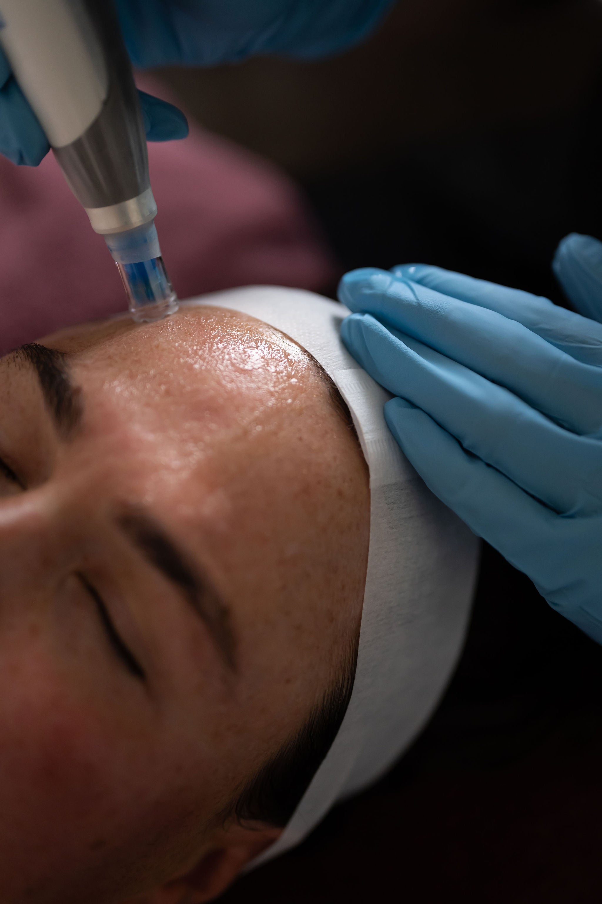 Skin Needling Package – Buy 4, Receive a $250 Bonus