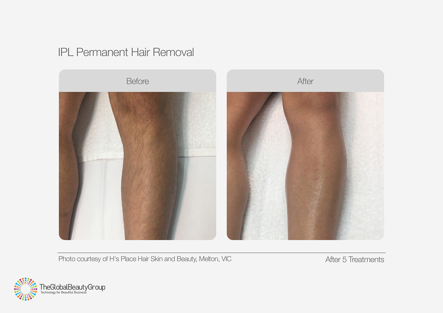 IPL Hair Removal - Buy 4 Get 2 FREE