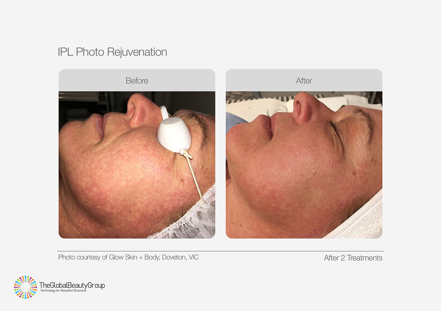 IPL Photo Rejuvenation - 3 Sessions