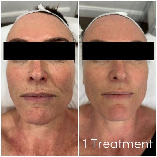 Larimedical Skin Peel Treatment Results