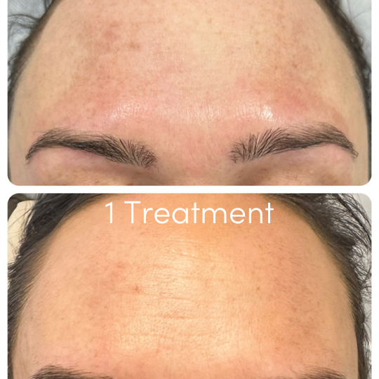 Larimedical Skin Peel Treatment Results