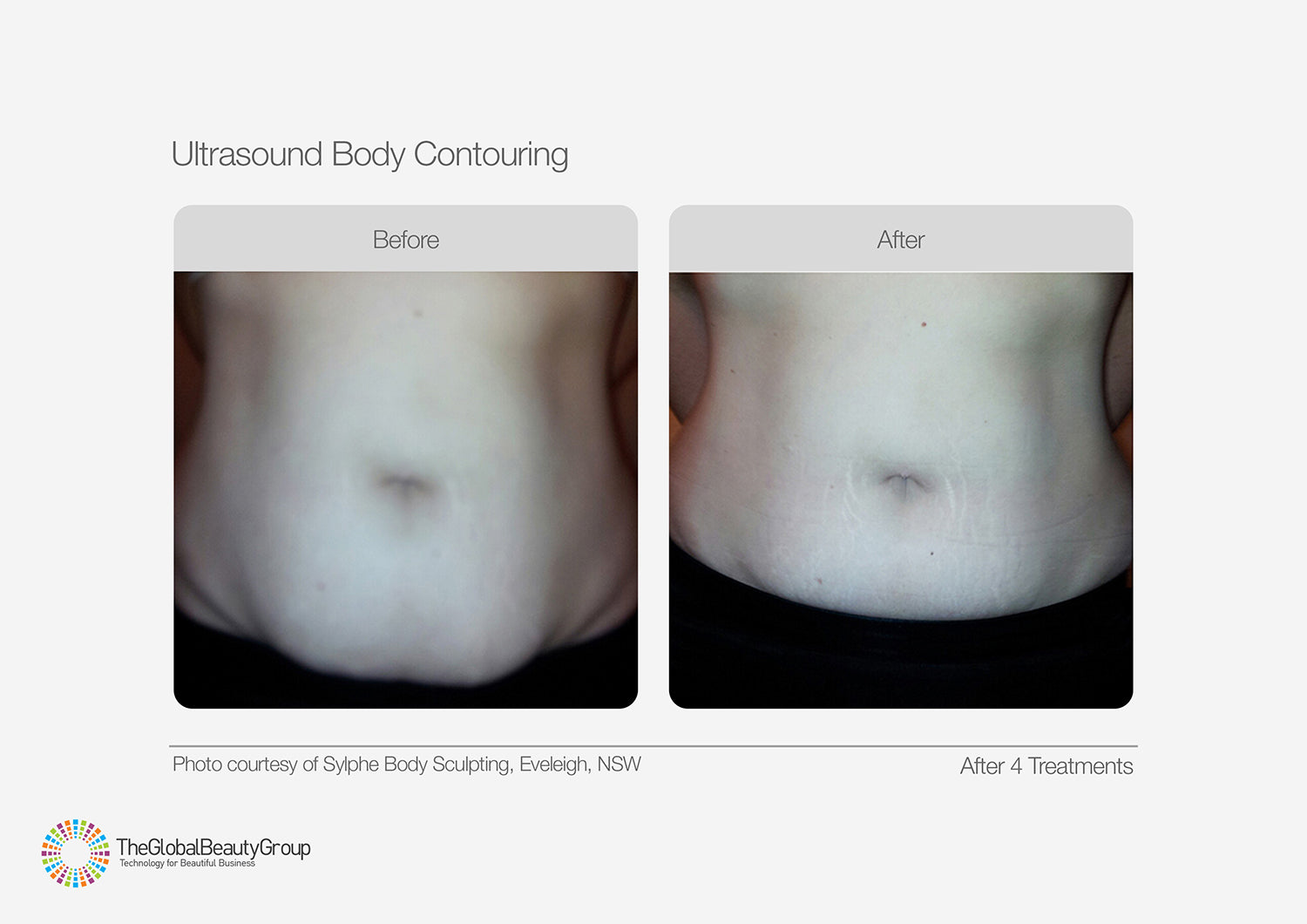 Body Contouring - Buy 4 Get 4 FREE